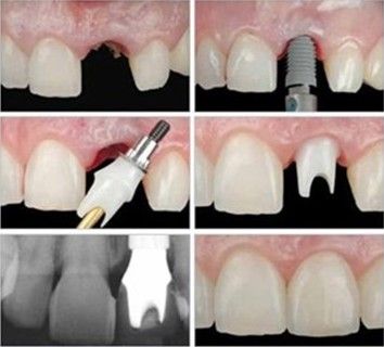 Arte e Face O que são implantes osseo integrados?   São uma nova geração de implantes, introduzidos a partir da década de 60, mas que só agora atingem um grau de aceitabilidade pela...