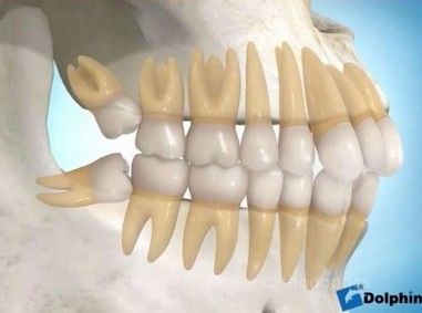 Arte e Face - Siso impactado, mostrando o contato ntimo do siso contra a raiz do dente vizinho, onde acontecem as reabsores